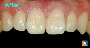 前歯の虫歯を保険でキレイに治す