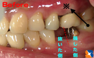 歯を守る　残す