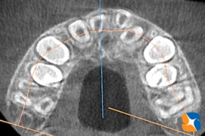 上からの断層で前後の歯並びをチェック