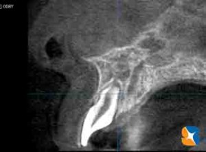 横からの断層で歯根周囲の骨の厚みをチェック