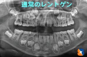 通常のレントゲンで歯並びを正しく予測するのは難しい
