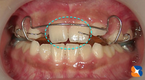 上下にプレート装置とリンガルアーチ装置を装着