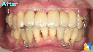 上：前歯にセラミックの５連結装着