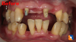 抜歯を最低限に抑えて出来るだけ歯を残した
