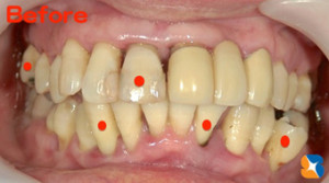 グラグラしていて噛めない
