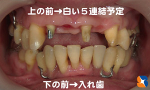 下に入れ歯を装着