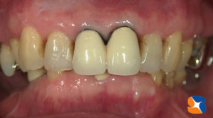 歯茎の際が黒い