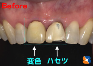 保険の前歯　黄色に変色　割れる