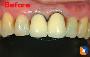 前歯の変色／際の黒み