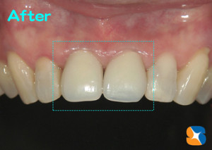 白めに設定の保険の前歯