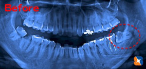 抜歯前のレントゲン