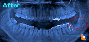 抜歯後のレントゲン