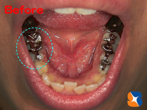 保険で入れた銀の詰め物