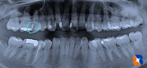 レントゲンで虫歯を説明されてもよく分からない