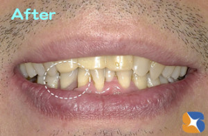 スッキリ目立たない入れ歯