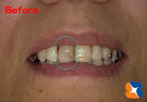 前歯が変色すると目立つ