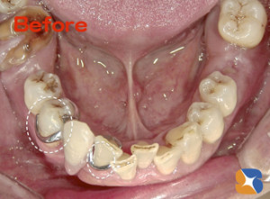 見た目の悪い入れ歯は使えない