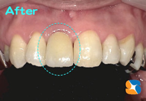 保険で変色を改善