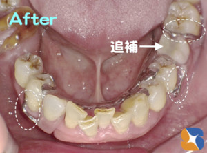 入れ歯で困っている方に是非作って欲しい当院の入れ歯