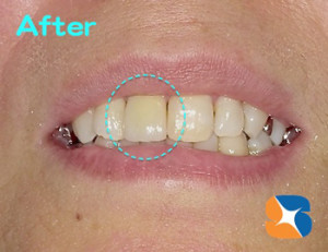 前歯がキレイになるとイメージも変わる