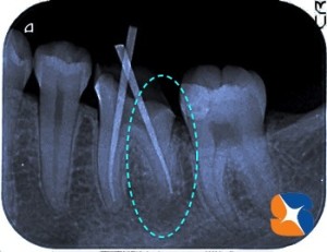 ２本が１本に見える一般的なレントゲン画像