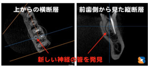 最新CTで歯を上からと前歯から輪切り診断