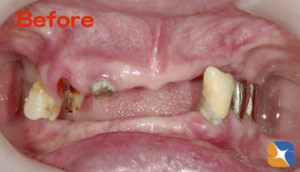 自分に合う入れ歯と出会えていない
