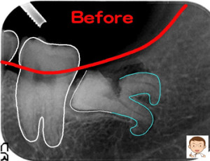 横向きで先が折れ曲がった親知らず