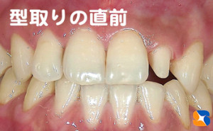 オールセラミックの型取り前