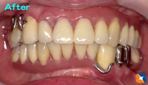 痛くない快適な入れ歯