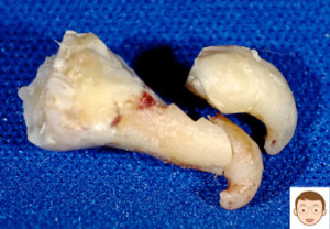 根の先が引っ掛って難航した親知らず