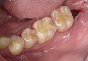 親知らずの抜歯痕