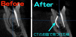 CTのお陰で神経の取り残しが回避