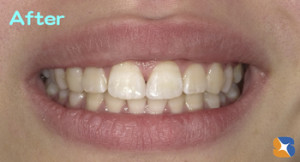 保険の樹脂の材料ですき間を埋める