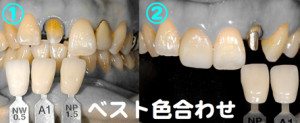 歯の色見本写真は超大切〜技工士と協同作業
