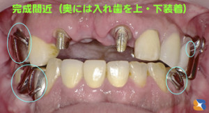 見た目の分からない保険の入れ歯