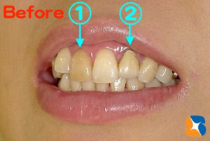 目立つ前歯の変色