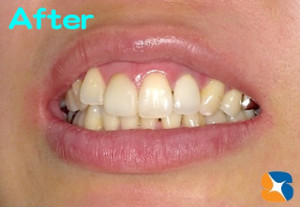 自然な仕上がりセラミック