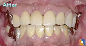 前歯は全て保険のさし歯