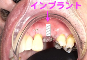 インプラント 石切 奈良