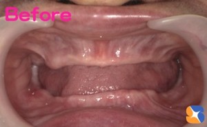 １本も歯がない　これで食事を続ける