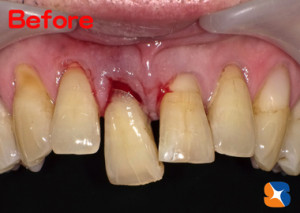 事故で前歯が抜けそう