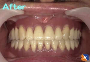 上・下　総入れ歯