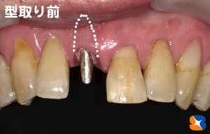 根を残して差し歯を被せる