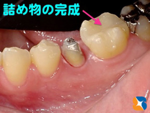 オールセラミックスの詰め物が完成