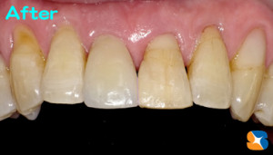 歯を残して部分入れ歯や連結ブリッジを回避