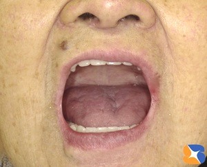 お口を全開しても入れ歯は落ちてこない