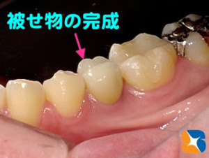 オールセラミックスの被せ物が完成