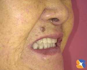 見た目も美しい入れ歯