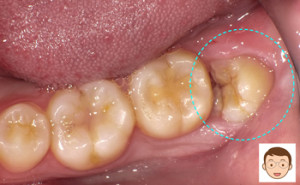 横向きの親知らず　CTでチェック
